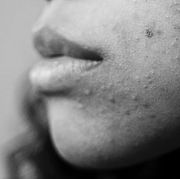 benzoyl peroxide washes benzoyl peroxide washes